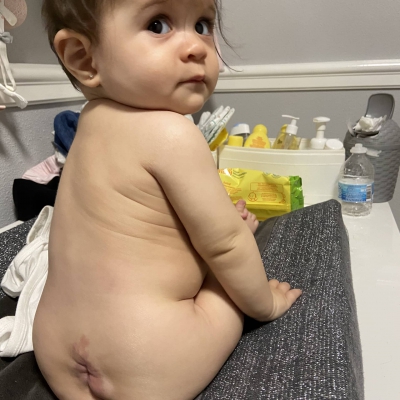 Baby Zoë had een open ruggetje bij de geboorte