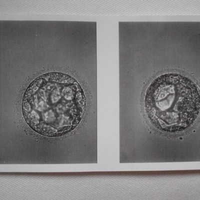 Tijdens de IVF-punctie prikte de gynaecoloog een bloedvat in mijn buikholte aan