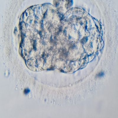 Na de IVF punctie kreeg ik ondraaglijke pijn