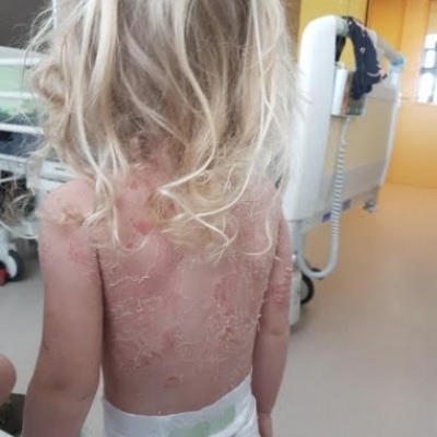 Ilvy had ineens brandblaren over haar hele lichaam